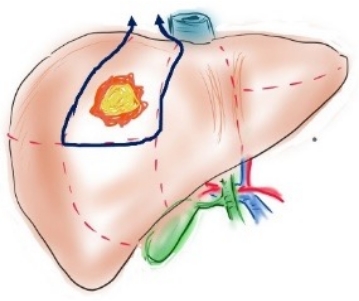 S8領域に肝細胞がん（腫瘍）があった場合矢印の範囲を切除する