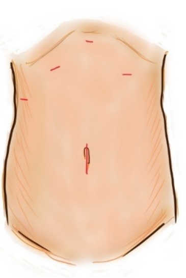 腹腔鏡下肝切除の創は整容面で優れています。