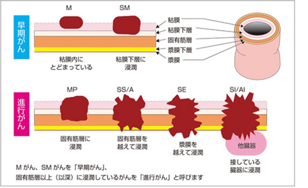 結腸ポリープの形状と成長パターン