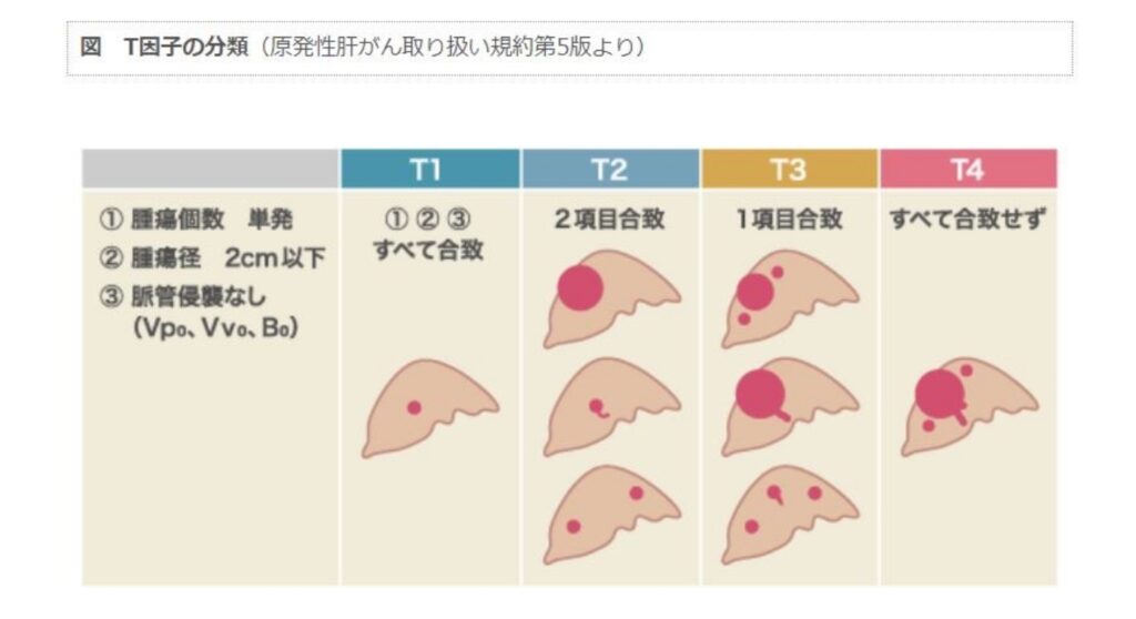 T因子の分類（原発性肝がん取扱い規約第5版より）