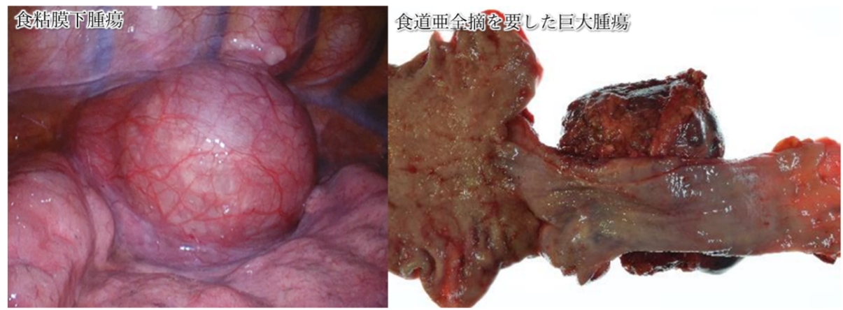 食粘膜下腫瘍、食道亜全摘を要した巨大腫瘍