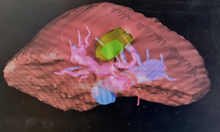 術前のシミュレーション画像
